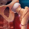 osteomalacia-Osteoporosis-radiolucenc-استئوبلاست ها-استئوپروز-استئوکلاستها-استخوان-استخوان خوارها-استخوان سازها-پوکی استخوان-تولید مجدد استخوان-درد استخوان-ریختشناسی استخوان-شکستگی های میکروسکوپی-کاهش توده استخوانی-کلسیم مکمل-نرمی استخوان-یائسگی