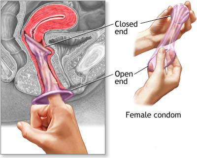 کاندوم زنانه (Vaginal pouch) 