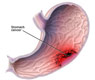 stomach cancer-آندوسکوپی-بیوپسی-تشخیص سرطان معده-درد معده-درمان سرطان معده-سرطان-سرطان معده-سلولهای گلاندولر-علائم سرطان معده-معده-نمونه برداری