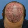 پوست و مو-پیوند-پیوند مو-جلوگیری از ریزش مو-درمان ریزش مو-ریزش مو-ریزش موی سر-طاسی-کاشت مو-کاشت موی طبیعی-موی بدن